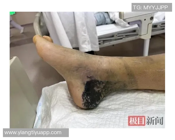 米体报道S希门尼斯考虑右脚踝手术决定将在未来几天做出